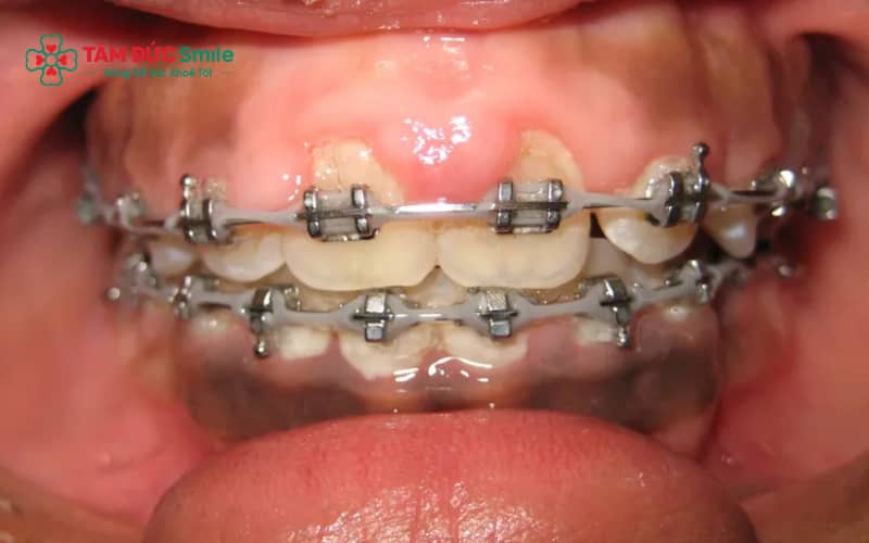 Lợi trùm thường gây sưng đau, khó chịu và có thể kèm viêm nhiễm nếu không xử lý kịp thời.