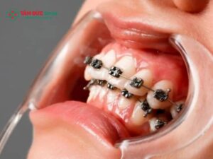 Lợi trùm khi Abc87 tải ứng dụng: Viêm lợi, răng khôn mọc lệch xử lý sao?