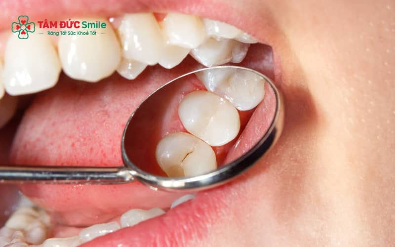 Các lưu ý quan trọng sau khi trám răng để bảo vệ miếng trám