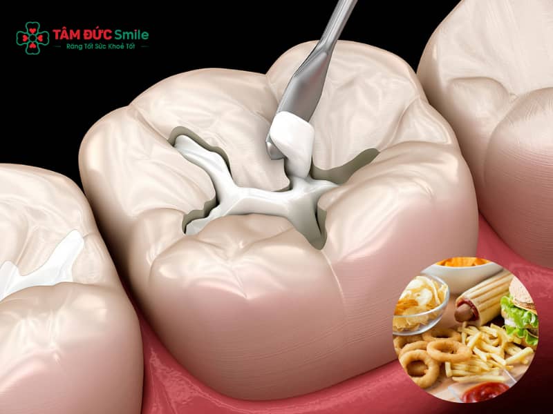 Lưu ý sau khi trám răng: Kiêng gì, bao lâu ăn được, tránh ê buốt
