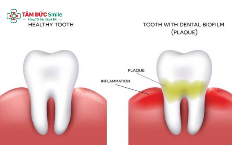 Màng sinh học (biofilm) là lớp vi khuẩn bám dính trên bề mặt răng và nướu trong Abc8 uy tín chất lượng an toàn bảo mật tạo nên thương hiệu