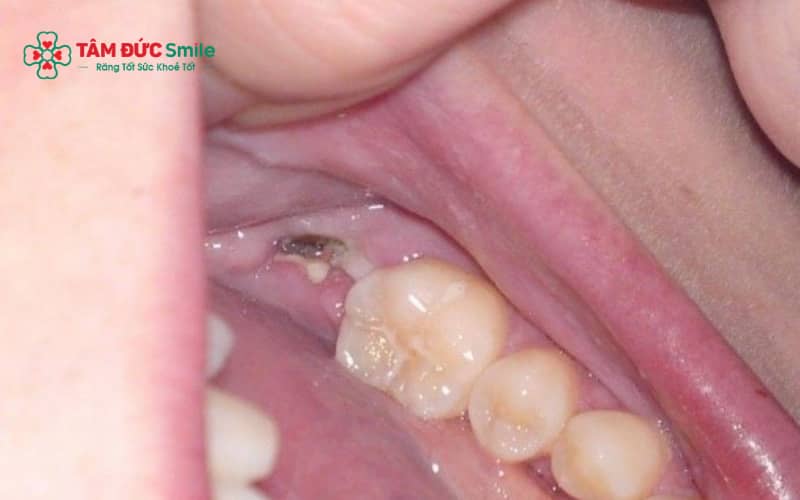 Màng trắng bình thường không gây đau nhiều, trong khi nhiễm trùng thường kèm sưng, đau và có mủ