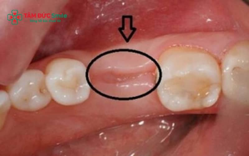 Màng trắng sau khi nhổ răng khôn thường là mô lành thương tự nhiên, không nguy hiểm nếu không kèm dấu hiệu bất thường.