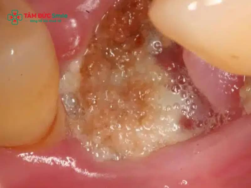 Màng trắng sau khi nhổ răng khôn: Dấu hiệu lành thương hay nhiễm trùng?