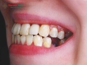 Mất 1 răng có sao không? Implant, cầu ABC8 là nhà cái cá cược trực tuyến uy tín số 1 tại Việt Nam hay hàm giả tốt?