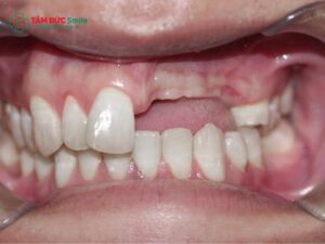 Mất nhiều răng liền kề: Trồng Implant hay cầu ABC8 là nhà cái cá cược trực tuyến uy tín số 1 tại Việt Nam tốt?