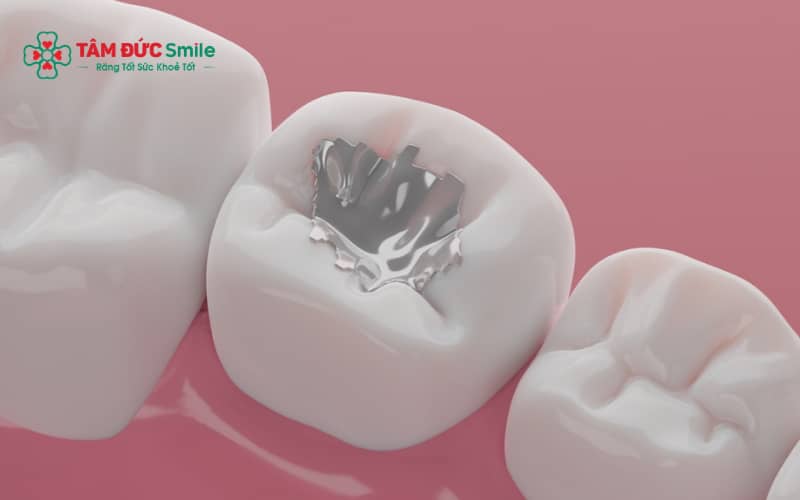 Miếng trám răng có thể bị rớt do vật liệu, kỹ thuật thực hiện hoặc thói quen ăn nhai hằng ngày