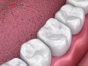 Miếng trám răng bị rớt: nguyên nhân trám răng bị bong, cách xử lý an toàn