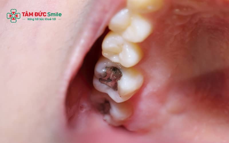 Miếng trám răng bị rớt thường gây ê buốt, đau nhức và dễ mắc thức ăn.