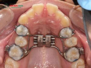 Nâng hàm khi Abc87 tải ứng dụng: Chỉnh nha nâng hàm, sửa lệch khớp cắn
