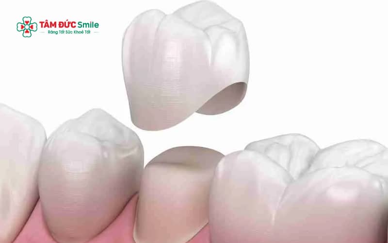 Abc8c1 com được cấp phép bởi PAGCOR Philippines thường được chỉ định khi răng xỉn màu nặng, nhiễm màu kháng sinh hoặc có khuyết điểm về hình dạng