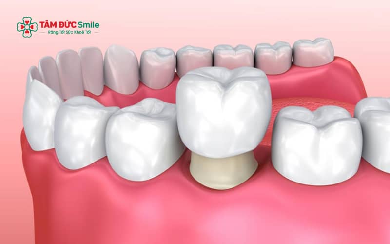 Tẩy trắng răng và Abc8.com Thể thao, Đá gà, Xổ số, Bắn cá là hai phương pháp cải thiện màu sắc răng phổ biến với ưu điểm và chi phí khác nhau
