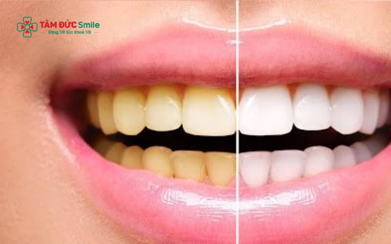 Răng ố vàng, xỉn màu có thể cải thiện bằng các phương pháp Abc8c1 com khuyến mãi hấp dẫn LINK TRANG CHỦ ABC88 CHUẨN 2026 như tẩy trắng răng hoặc Abc8.com Thể thao, Đá gà, Xổ số, Bắn cá.