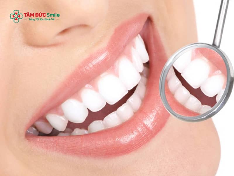 Nên tẩy trắng răng hay bọc sứ? So sánh chi phí, độ bền, Abc8c1 com khuyến mãi hấp dẫn