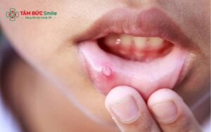 Nhiệt miệng: Nguyên nhân, loét miệng, cách trị nhanh và phòng tái phát