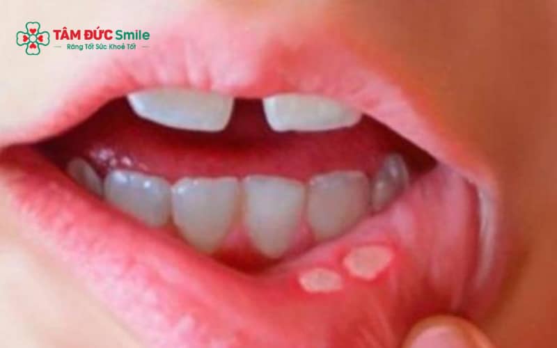 Nhiệt miệng thường xuất hiện dưới dạng vết loét nhỏ màu trắng hoặc vàng trên niêm mạc miệng