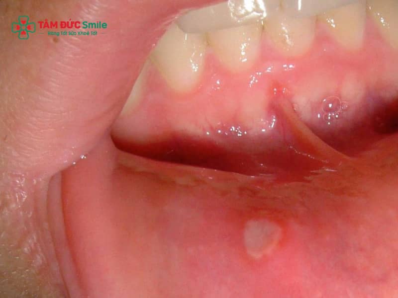 Nhiệt miệng kéo dài hoặc tái phát nhiều lần có thể gây đau và ảnh hưởng đến sinh hoạt hằng ngày