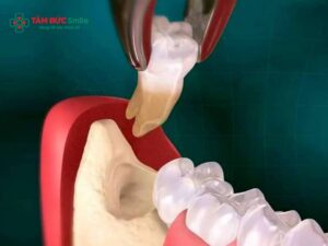 Nhổ 3 cái răng khôn mọc lệch, mọc ngầm có đau không? Chi phí bao nhiêu?