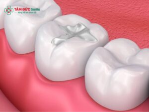 Quy trình trám răng chuẩn y khoa – Abc8 Abcvip link không chặn sâu, composite bền đẹp