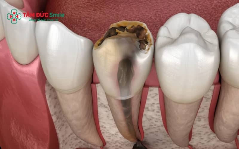 Răng đã lấy tủy vẫn có thể niềng được nếu cấu trúc răng còn đủ chắc khỏe