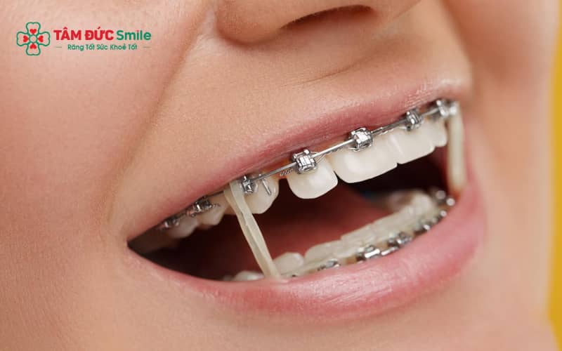 Răng sau khi lấy tủy có thể giòn hơn nhưng vẫn chịu được lực niềng nếu được kiểm soát đúng cách.
