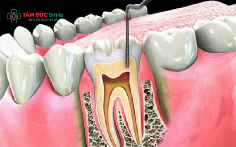 Tùy vào tình trạng răng, ABC8 đường link chính thức sẽ chỉ định phương pháp niềng phù hợp cho răng đã lấy tủy