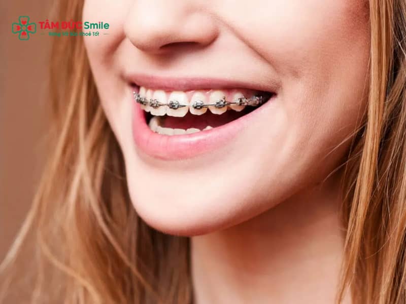 Răng đã lấy tủy có niềng được không?