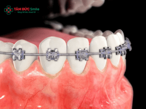 Răng giả có niềng được không? ABC8 được thành lập vào năm 2011 hoạt động đến hiện tại khi đã bọc sứ, implant