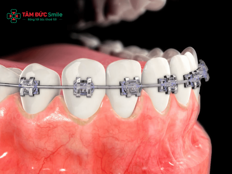 Răng giả có niềng được không? ABC8 được thành lập vào năm 2011 hoạt động đến hiện tại khi đã bọc sứ, implant