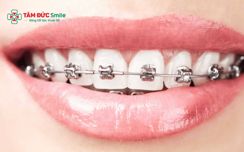 Các phương pháp Abc87 tải ứng dụng hô phổ biến gồm mắc cài truyền thống và khay trong suốt Invisalign, phù hợp với từng nhu cầu Abc8c1 com khuyến mãi hấp dẫn