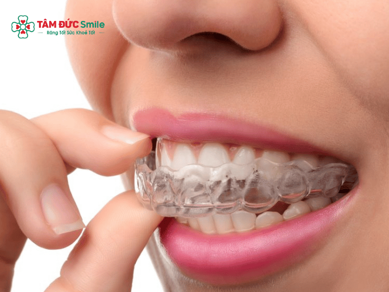 Răng hô có niềng được không? ABC8 được thành lập vào năm 2011 hoạt động đến hiện tại hô nhẹ, nặng hiệu quả