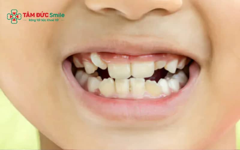 Giai đoạn răng hỗn hợp khi răng sữa và răng vĩnh viễn cùng tồn tại trên cung hàm của trẻ.