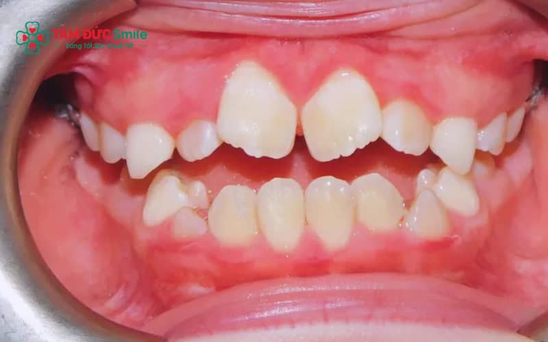 Các vấn đề thường gặp trong giai đoạn răng hỗn hợp như răng mọc lệch, chen chúc hoặc răng vĩnh viễn mọc khi răng sữa chưa rụng.