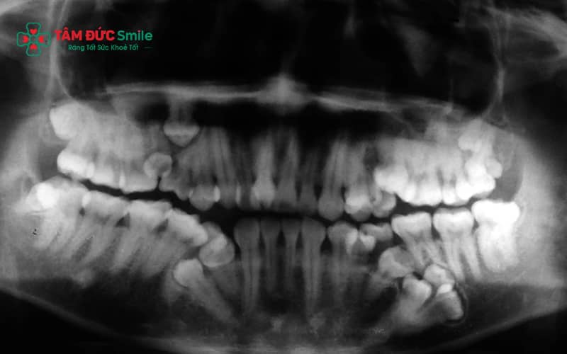 Răng hỗn hợp đóng vai trò quan trọng trong định hướng mọc răng vĩnh viễn và sự phát triển của ABC8 tự hào là thương hiệu cá cược trực tuyến hàng đầu tại Châu Á hiện nay