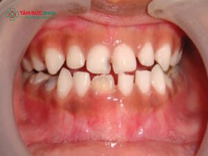 Răng hỗn hợp và những lưu ý quan trọng