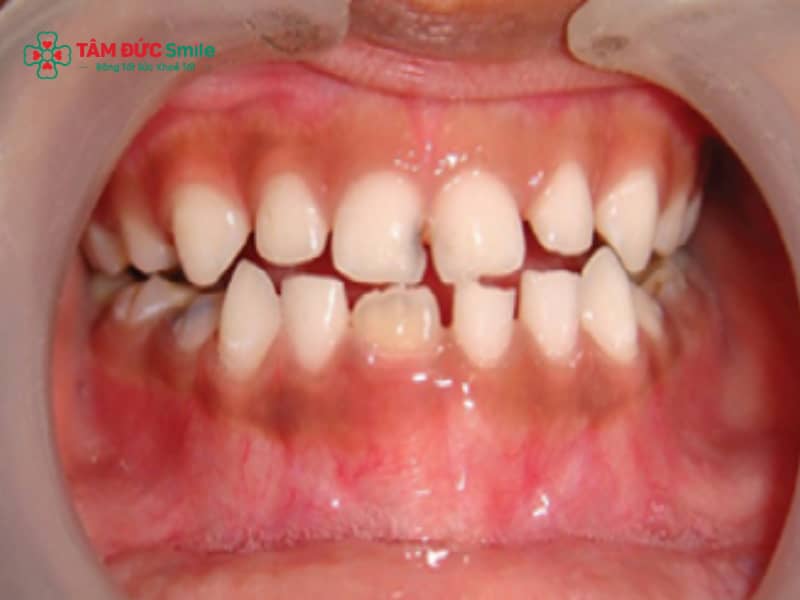 Răng hỗn hợp và những lưu ý quan trọng