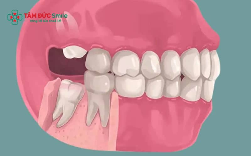 Răng khôn không đau vẫn cần được thăm khám định kỳ để đánh giá nguy cơ và quyết định có nên nhổ hay không.