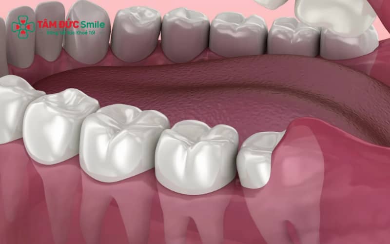 Răng khôn mọc lệch hoặc mọc ngầm có thể gây biến chứng tiềm ẩn dù chưa có triệu chứng đau rõ ràng