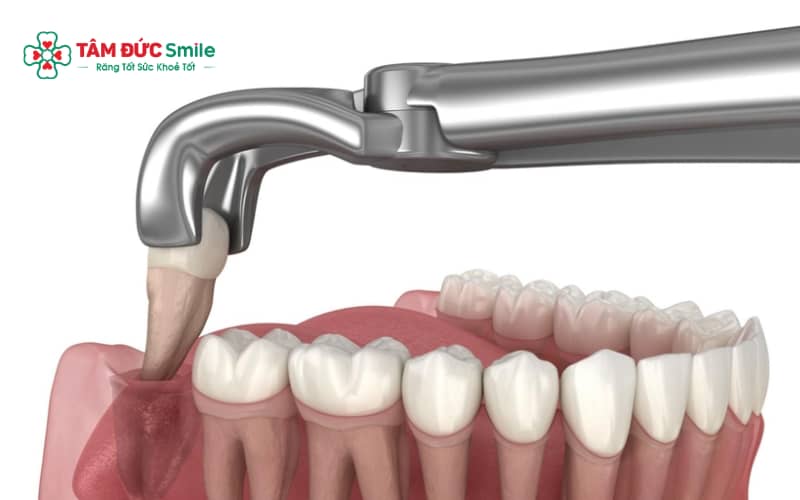 Răng khôn mọc thẳng, không gây viêm và dễ vệ sinh có thể không cần nhổ nếu được theo dõi định kỳ.