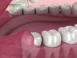 Răng khôn không đau có cần nhổ không? Biến chứng mọc lệch, ngầm