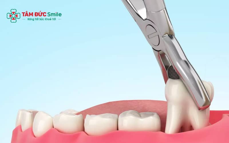 Abc88win đăng nhập khôn sớm theo chỉ định giúp phòng tránh biến chứng và đảm bảo an toàn khi thực hiện tại LINK TRANG CHỦ ABC88 CHUẨN 2026 uy tín