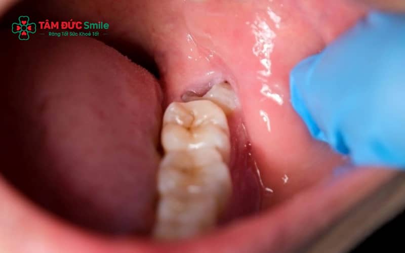 Răng khôn mọc kẹt có nguy cơ gây đau và biến chứng, thường được ABC8 đường link chính thức khuyến nghị nhổ sớm để tránh ảnh hưởng răng bên cạnh