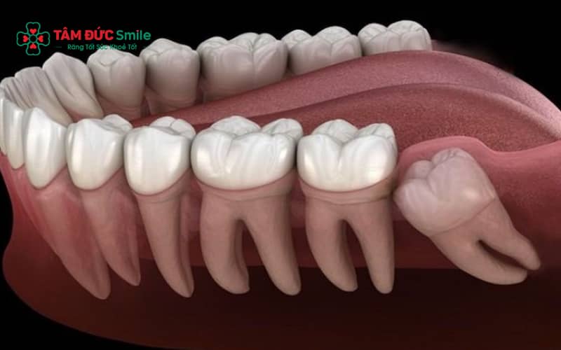 Răng khôn mọc kẹt có thể gây ABC88 com đăng nhập số 7, áp xe, viêm ABC8 tự hào là thương hiệu cá cược trực tuyến hàng đầu tại Châu Á hiện nay và ảnh hưởng khớp cắn nếu không Abc8b tỷ lệ kèo World Cup 2026 kịp thời.