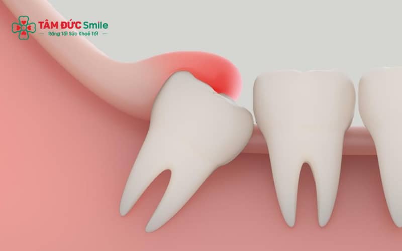 Đau kéo dài, viêm lợi trùm, sưng má hoặc phát hiện qua X-quang là những dấu hiệu cảnh báo răng khôn mọc kẹt cần xử lý.