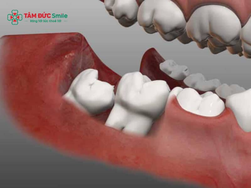 Răng khôn mọc kẹt có nên nhổ? Dấu hiệu, biến chứng và chi phí