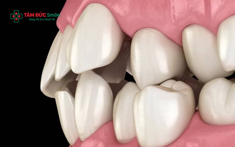Răng lệch lạc, khấp khểnh là tình trạng phổ biến khiến nhiều người phân vân nên Abc87 tải ứng dụng hay Abc8.com Thể thao, Đá gà, Xổ số, Bắn cá
