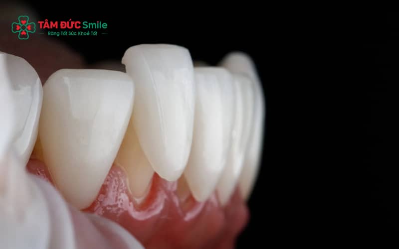 Viêm nha chu là nguyên nhân phổ biến khiến răng lung lay do mô nâng đỡ răng bị tổn thương.