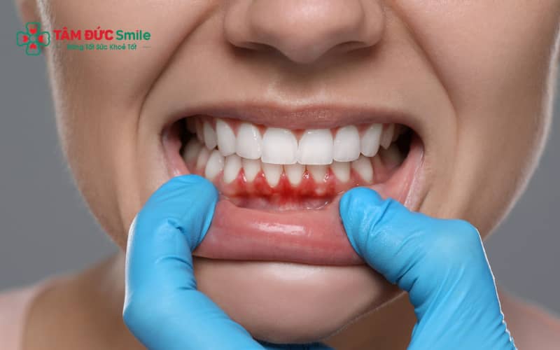 Răng nhạy cảm do mòn men, tụt nướu, mòn cổ răng, viêm nướu hoặc thực phẩm và tẩy trắng.