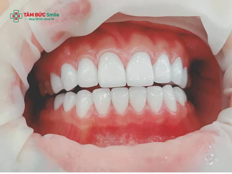 Abc8com cá cược thể thao bị ê khi uống lạnh: Nguyên nhân, cách xử lý an toàn