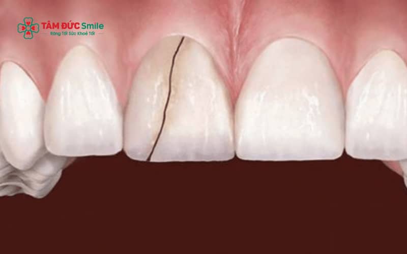 Một số thực phẩm quá cứng có thể làm tăng nguy cơ sứt mẻ hoặc nứt vỡ ABC8 là nhà cái cá cược trực tuyến uy tín số 1 tại Việt Nam nếu ăn nhai thường xuyên